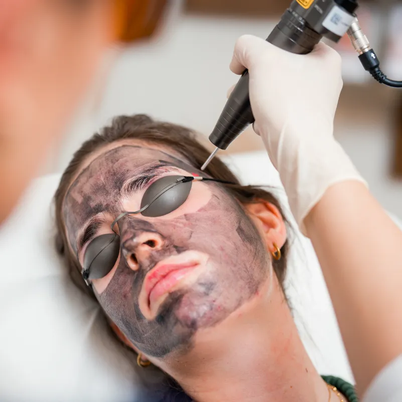 Carbon Peeling Hamburg in der Dermatologischen Privatpraxis Dr. Anna Brandenburg