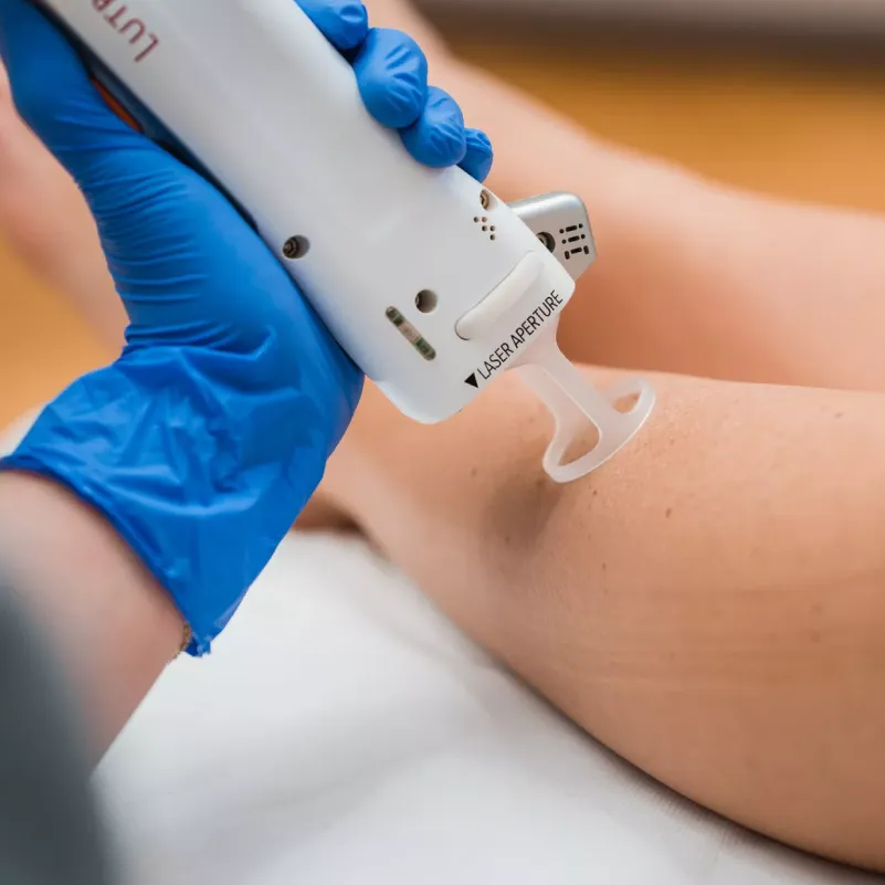 Epilationslaser Therapie in Hamburg für schonende dauerhafte Haarentfernung
