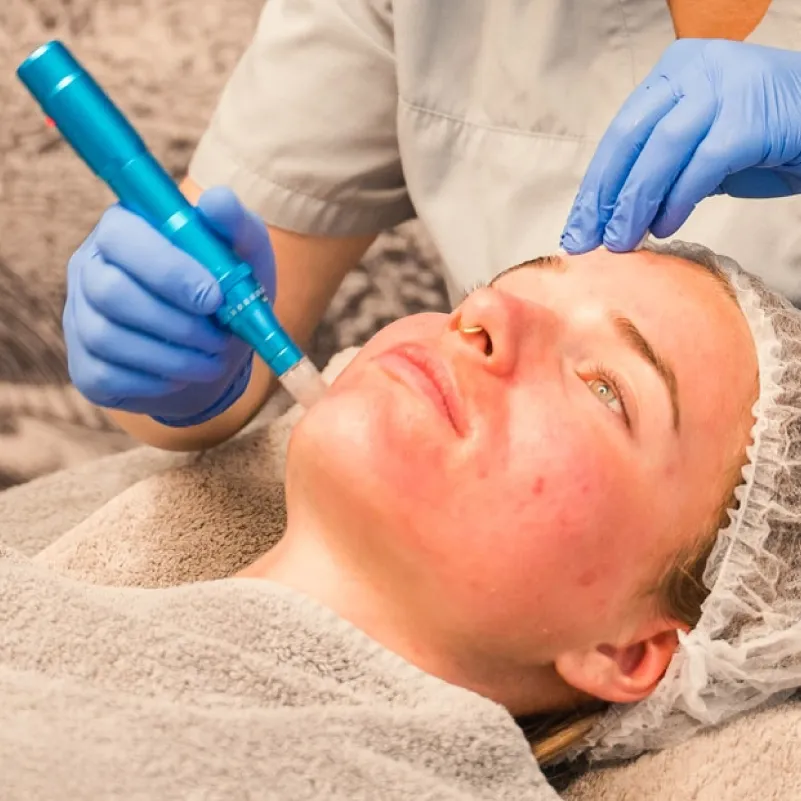 Effektive Hautverjüngung mit Microneedling Hamburg