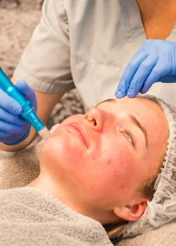 Microneedling Hamburg für effektive Hautverjüngung durch Zellanregung