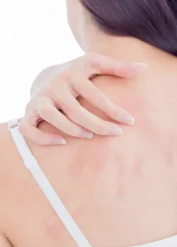 Medizinische Dermatologie Harvestehude bei Neurodermitis und Ekzemen
