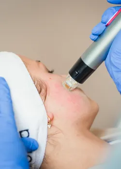 Radiofrequenz-Microneedling Hamburg zur intensiven Hautverjüngung