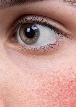Innovative Rosacea-Behandlung in Hamburg Harvestehude bei Dr. Anna Brandenburg