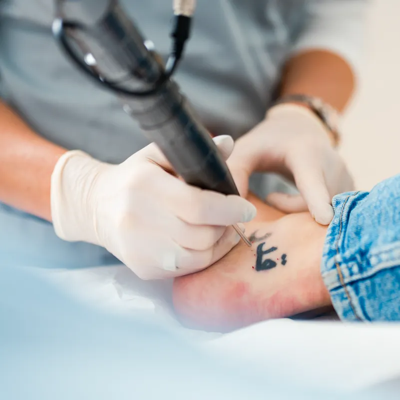 Tattooentfernung Hamburg durch präzise Laserbehandlung